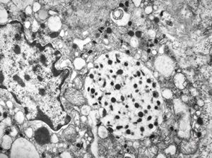 M, 38y. | pheochromocytoma